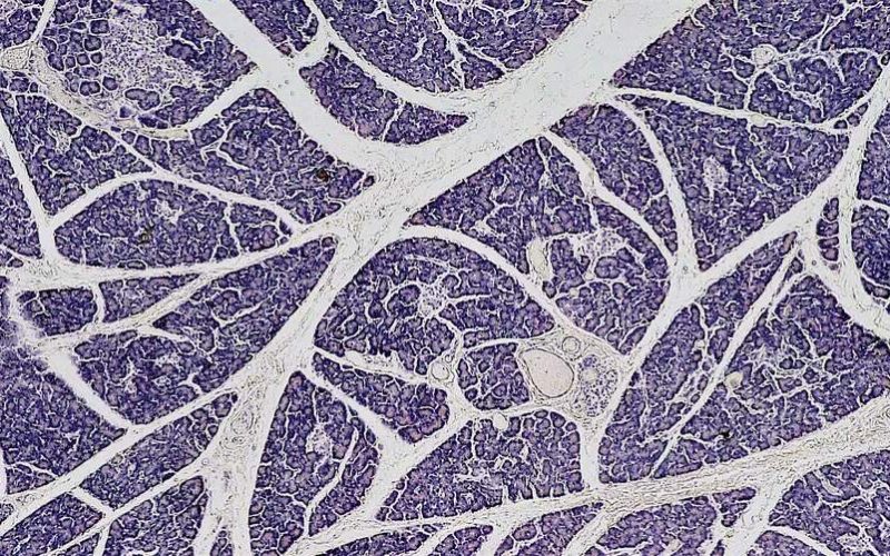 Desvendando o mistério do câncer pancreático: um desafio discreto para a medicina contemporânea