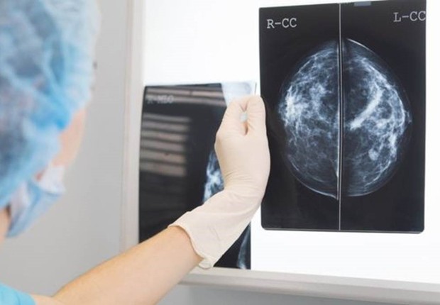 Avanços da inteligência artificial aceleram diagnósticos e identificam câncer de mama em estágios mais críticos