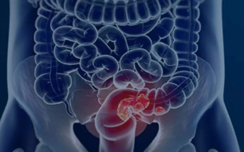 SUS implementa teste inovador para identificar câncer de intestino precocemente