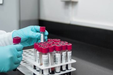 Exame de sangue revela potencial para antecipar risco de câncer de pulmão em até cinco anos antes do diagnóstico
