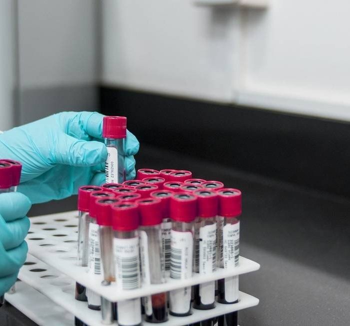 Exame de sangue revela potencial para antecipar risco de câncer de pulmão em até cinco anos antes do diagnóstico