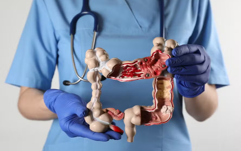 Crescimento alarmante de doenças inflamatórias intestinais no Brasil em uma década e meia